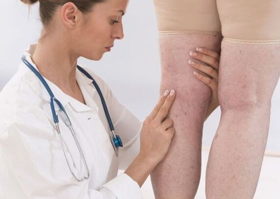 Diagnose von Krampfadern