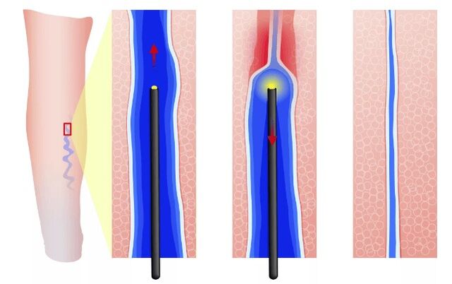 Endovasale Elektrokloagulation
